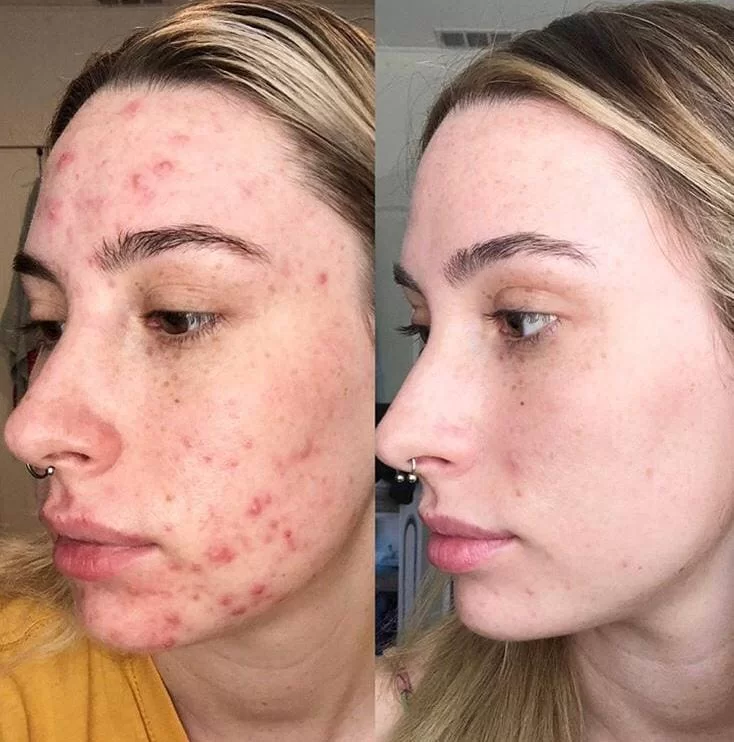Peeling con dermaplaning