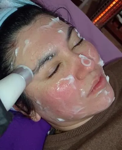 Peeling